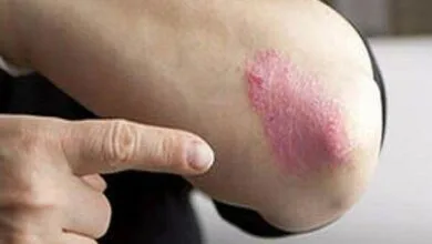 افراد مبتلا به لوپوس در معرض خطر بیماری قلبی