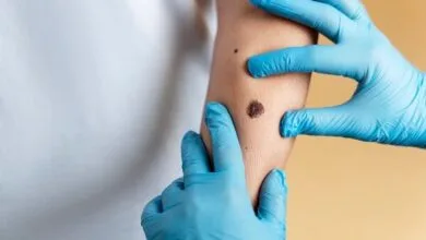 شایع ترین سرطان در جامعه؛ هرگز از سولاریوم استفاده نکنید