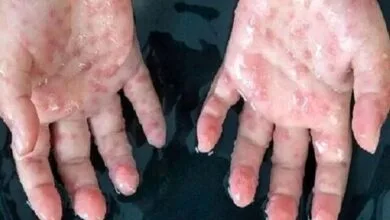 شناسایی مورد جدید سویه Ib آبله میمون در بریتانیا