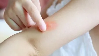 هشدار وزارت بهداشت درباره پشه آئدس هشدار وزارت بهداشت درباره پشه آئدس